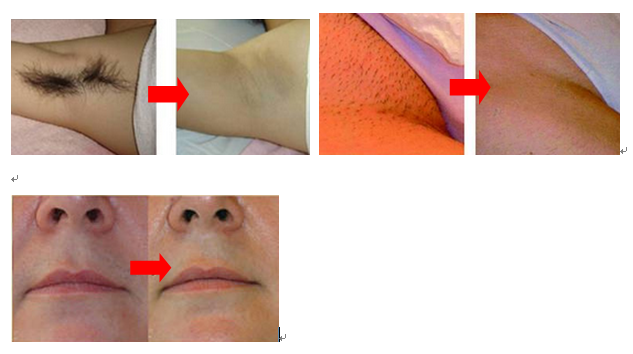 Depilazione professionale del ND Yag del corpo, macchina di depilazione del laser a diodi 808nm