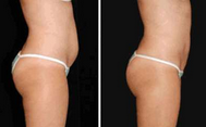Cavitazione ultrasonica della liposuzione di vuoto rf del laser a diodi di Lipo che dimagrisce consegna controllata a macchina