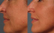 Cavitazione ultrasonica della liposuzione di vuoto rf del laser a diodi di Lipo che dimagrisce consegna controllata a macchina
