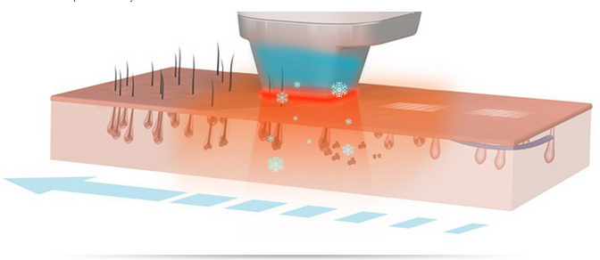 Micro Manica di DILAS che raffredda l'attrezzatura 600W di depilazione di 808 laser a diodi