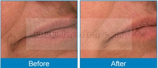 Attrezzature indolori di depilazione della macchina di depilazione del laser a diodi di bellezza 808nm di depilazione