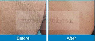 Attrezzature indolori di depilazione della macchina di depilazione del laser a diodi di bellezza 808nm di depilazione