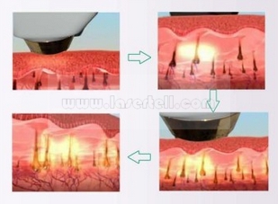 Attrezzature indolori di depilazione della macchina di depilazione del laser a diodi di bellezza 808nm di depilazione