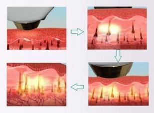 Prodotti permanenti facciali di depilazione con il raffreddamento chiuso di circolazione dell'acqua