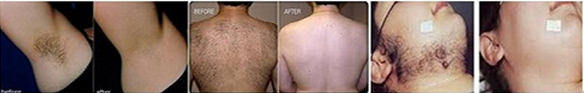 Micro Manica di DILAS che raffredda l'attrezzatura 600W di depilazione di 808 laser a diodi