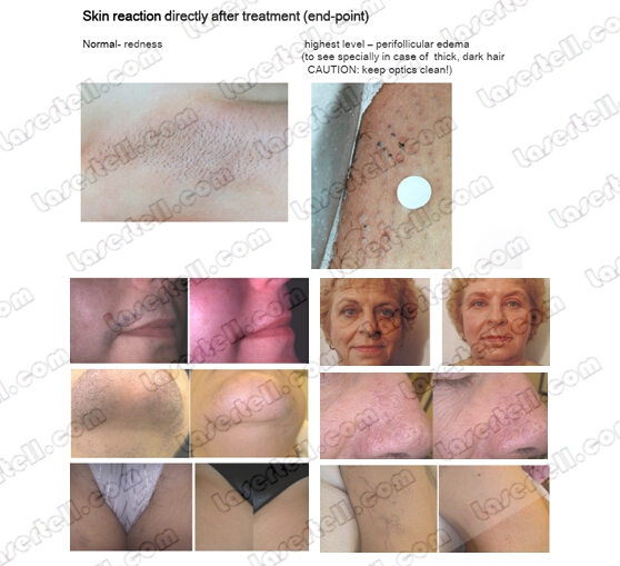 macchina di depilazione del laser dell'alessandrite di 10Hz SHR per il Facial/corpo/gamba