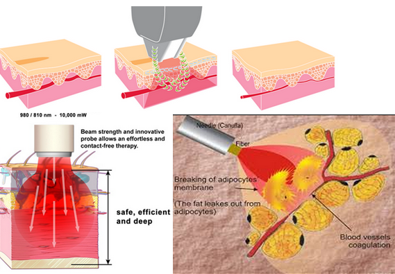 alta frequenza indolore 30MHZ del laser a diodi 635nm del ragno della vena della macchina rossa di rimozione