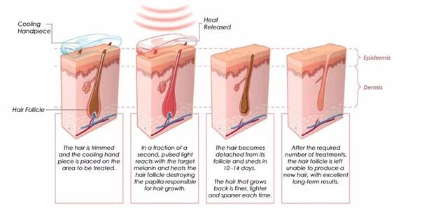 Raffreddamento TECNICO attivo di IPL della macchina permanente del laser con le barre del laser della Germania