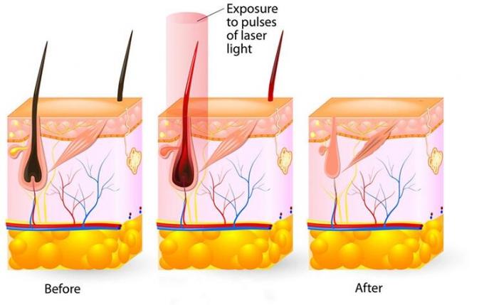 macchina verticale del laser di 600W 1200W IPL per depilazione permanente