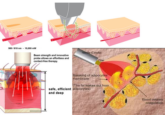 Macchina indolore di rimozione della vena del ragno, attrezzatura cosmetica del laser del diodo per EVLT